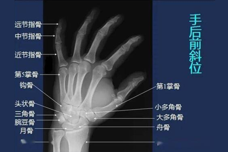 正常手部X线检查图