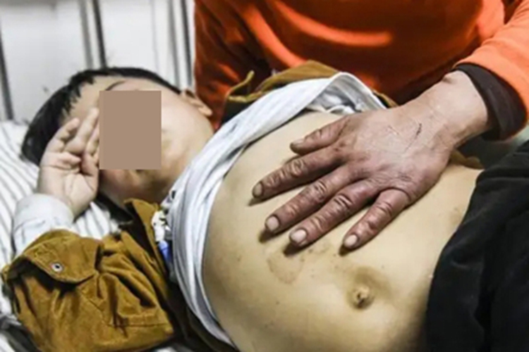 内脏利什曼病腹部肿大图 内脏利什曼病腹部肿大图