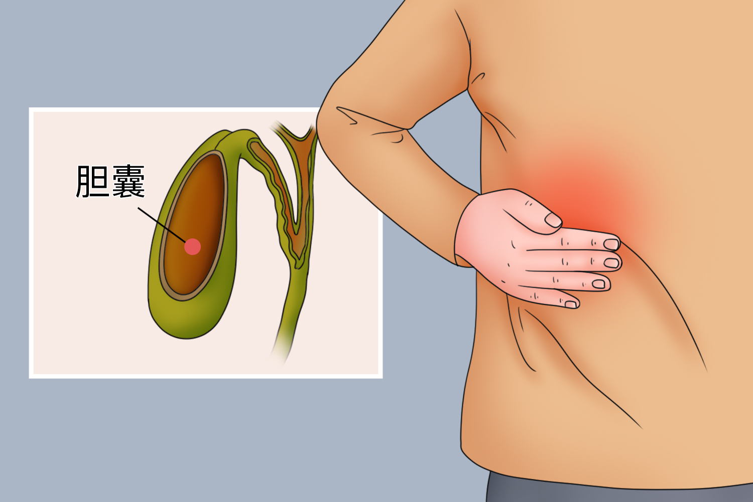 胆囊炎右上腹部疼痛图