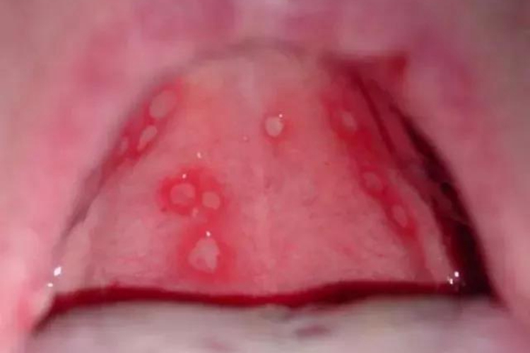 轻型阿弗他溃疡图 轻型阿弗他溃疡图