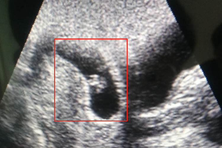 刚怀孕胎儿影像学形状图 刚怀孕胎儿影像学形状图