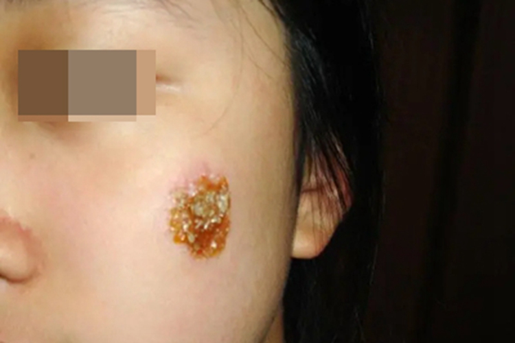 接触传染性脓疱疮结痂图