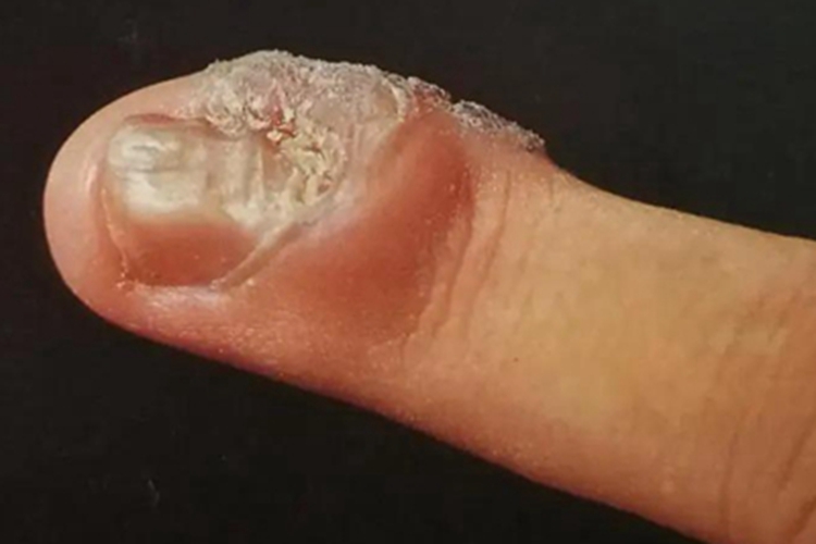 疣手指红肿图 疣手指红肿图