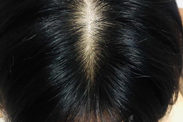 雄激素性脱发头顶发缝变宽图