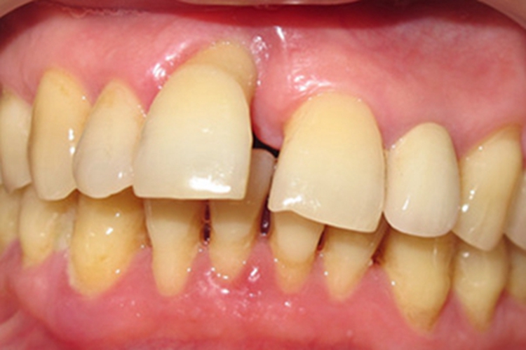 慢性牙周炎牙龈萎缩图 慢性牙周炎牙龈萎缩图