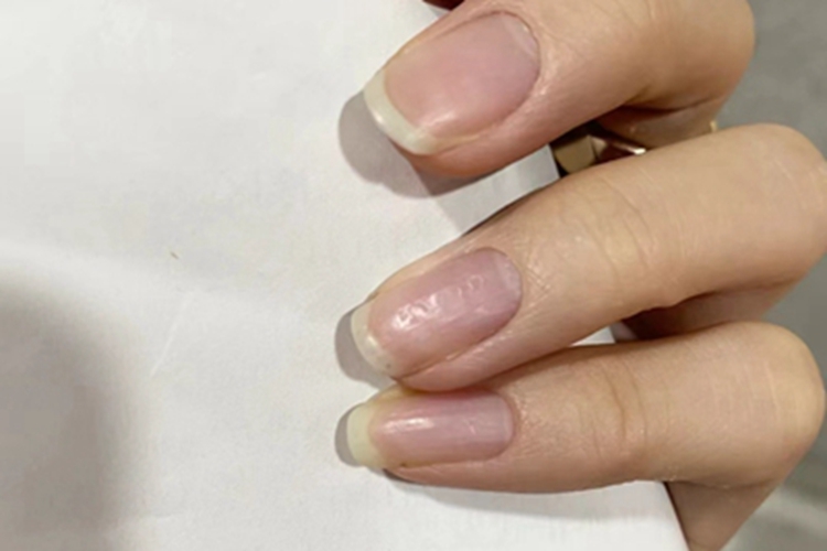 甲凹点指甲凹陷不平图