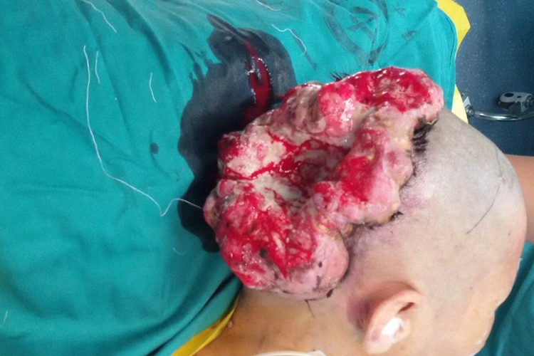 头部鳞状细胞癌症状图 头部鳞状细胞癌症状图