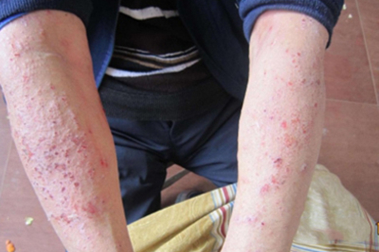 播散性神经性皮炎症状图 播散性神经性皮炎症状图