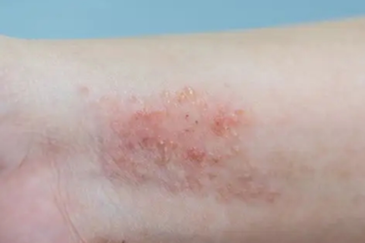 急性湿疹手腕红点图