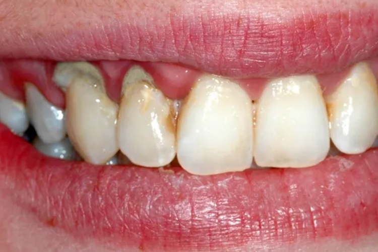 但上颌磨牙的腭根面也较易发生严重的牙龈萎缩