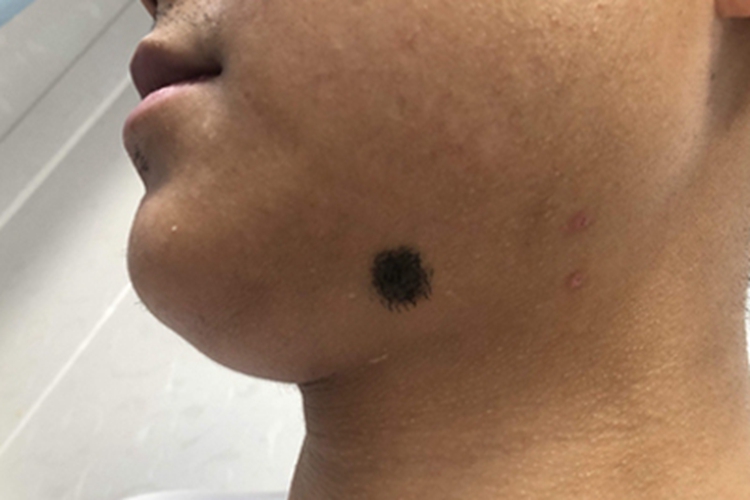 皮内痣下巴黑斑图