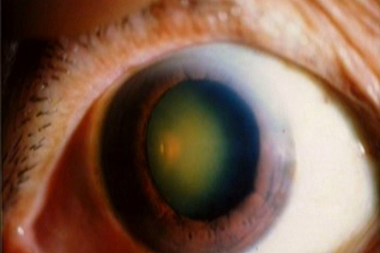 核性白内障眼球混浊图