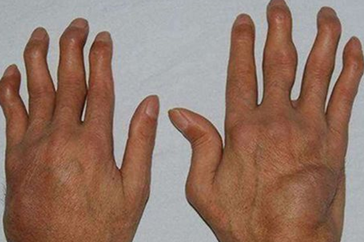 类风湿关节炎关节畸形图