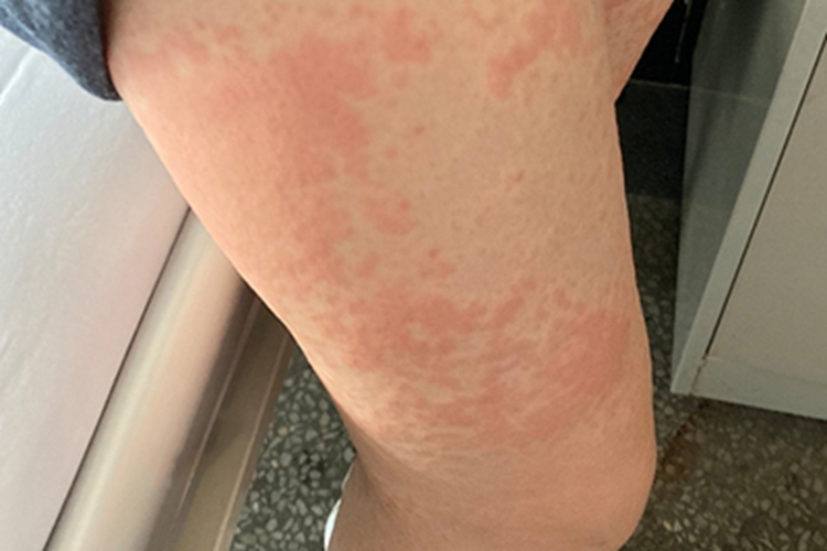 虫咬皮炎大腿红肿图