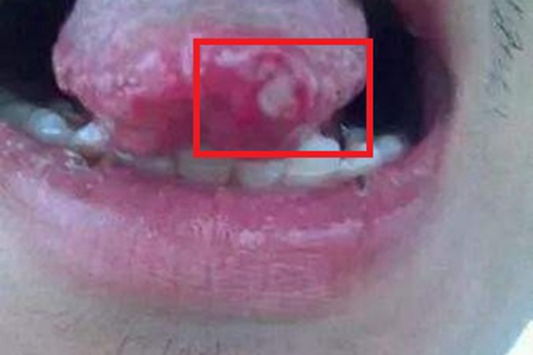 舌癌舌尖溃烂周围发红图 舌癌舌尖溃烂周围发红图