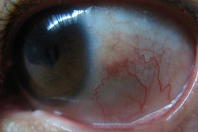 慢性细菌性结膜炎血丝图