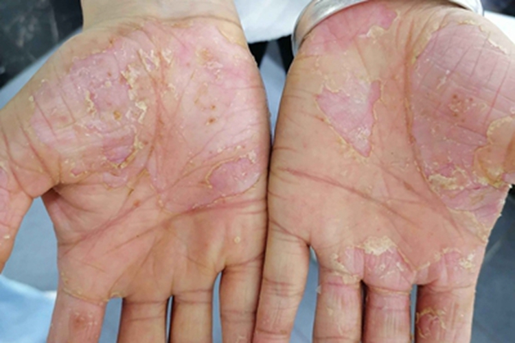 掌跖脓疱病皮肤发黄图