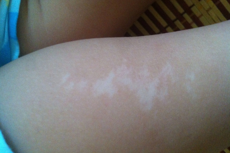 花斑糠疹大腿症状图