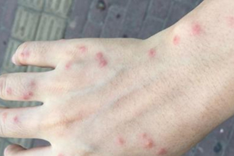 急性湿疹手背长红疙瘩图