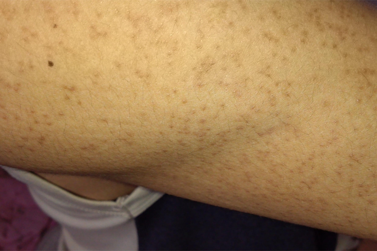 雀斑胳膊症状图