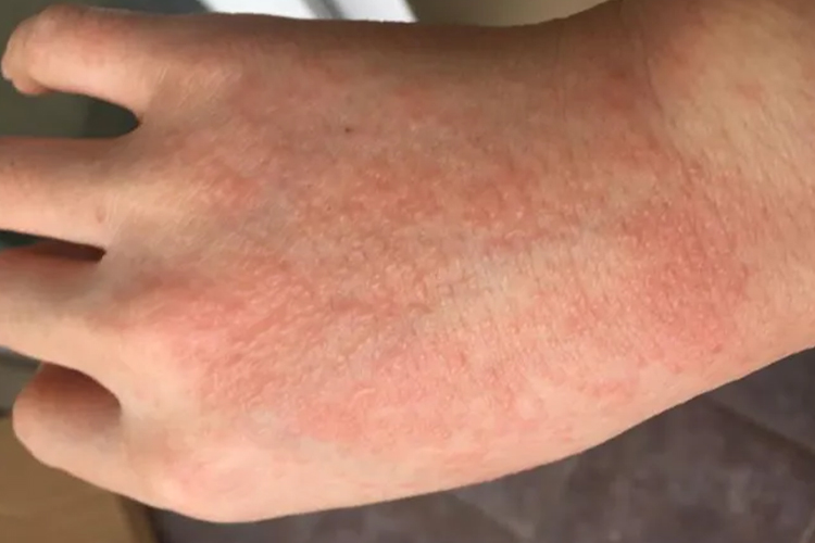 接触性皮炎手背疙瘩图
