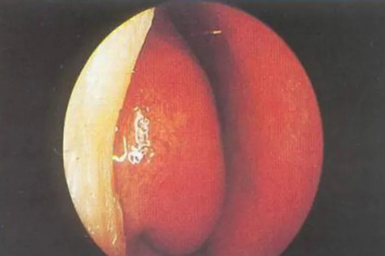 非变应性鼻炎图