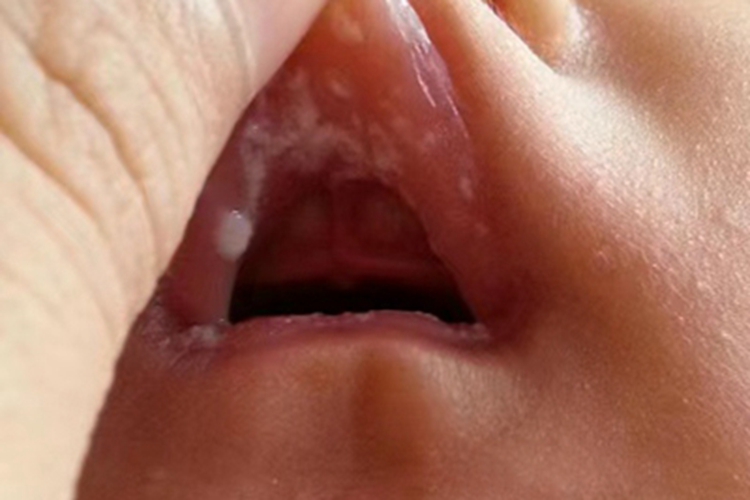 新生儿鹅口疮唇内侧症状图