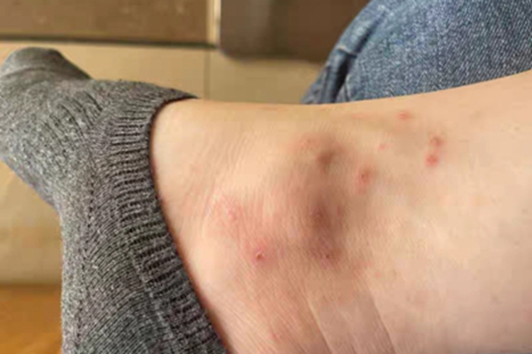 亚急性湿疹脚踝结节图 亚急性湿疹脚踝结节图