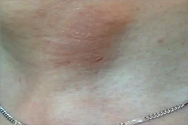 颈部假性皮萎缩前颈纹图 颈部假性皮萎缩前颈纹图