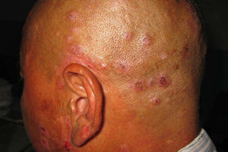 头皮脓疱糜烂性皮病头皮症状图