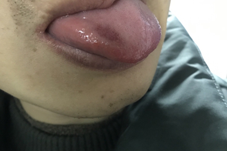 萎缩性舌炎舌头萎缩图