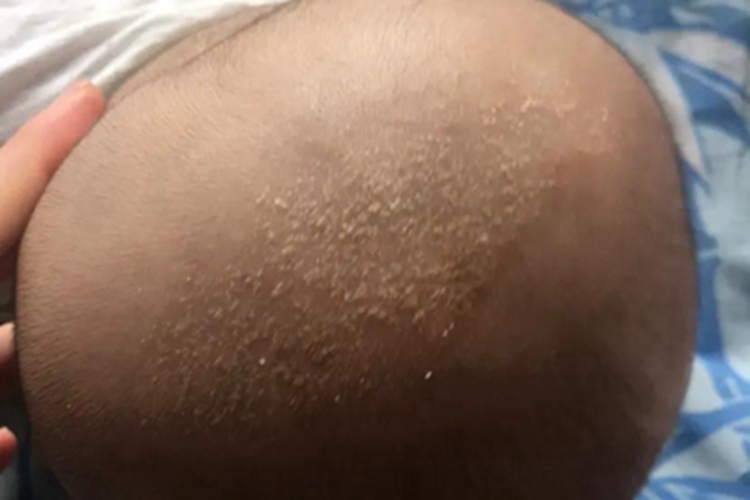 干性湿疹头皮脱屑图