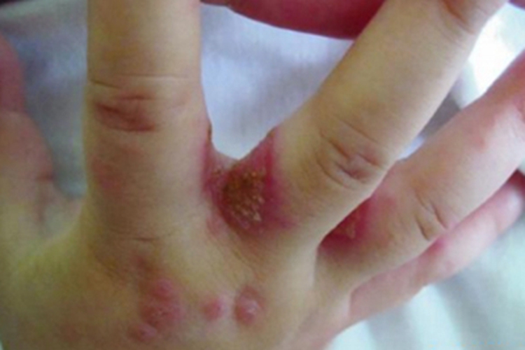 慢性黏膜皮肤念珠菌病指缝结痂图