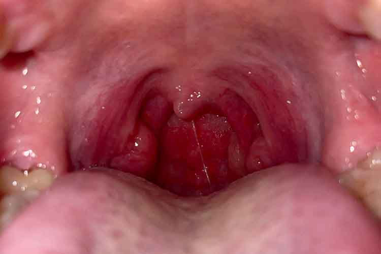 艾滋病初期咽喉炎红肿图