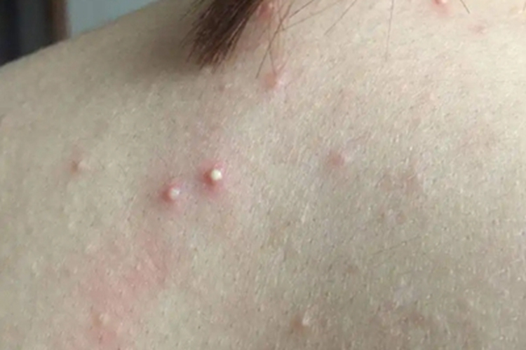 毛囊性脓疱病脓包图