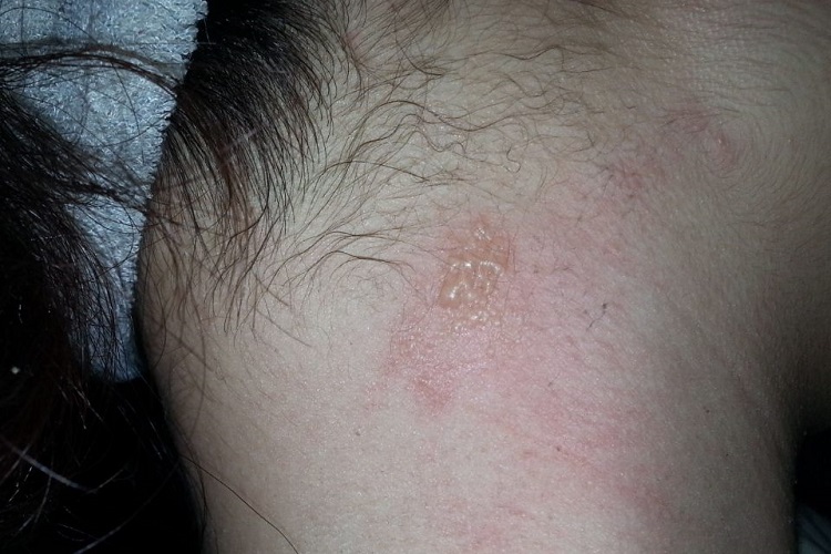 单纯疱疹颈部水疱图