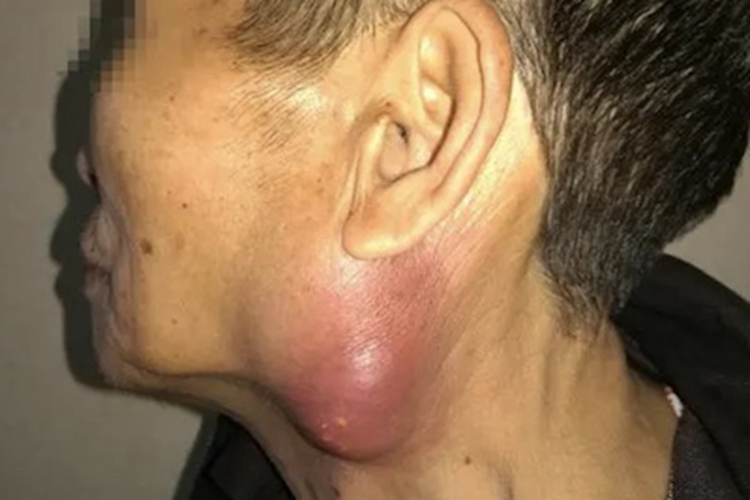 黏液表皮样癌大包图