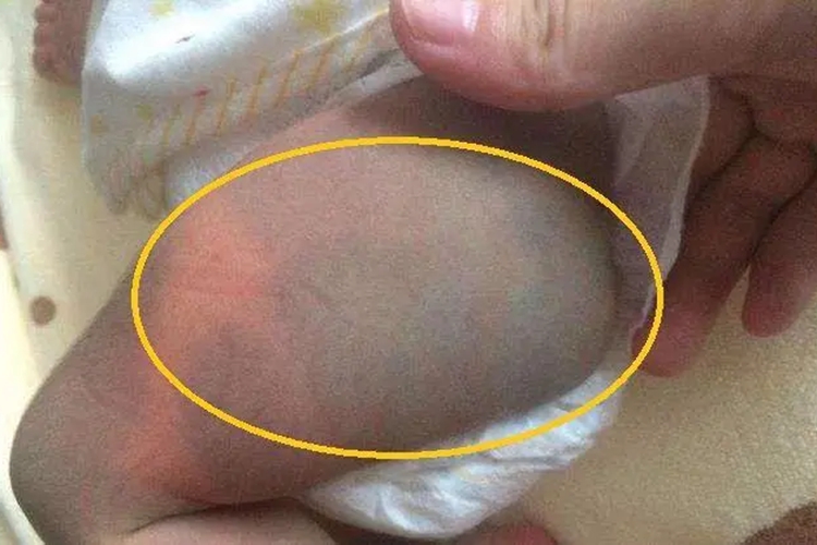 新生儿生理性紫绀图