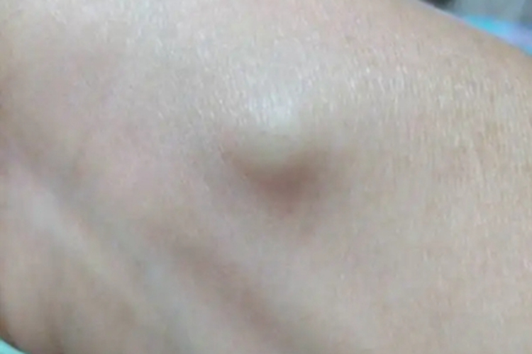 皮肤猪囊虫病包块图 皮肤猪囊虫病包块图