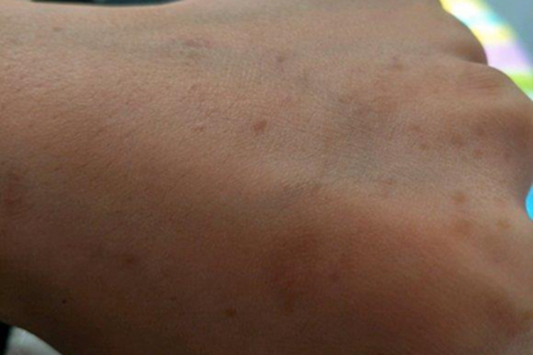 扁平疣手背上多个褐色斑点图 扁平疣手背上多个褐色斑点图