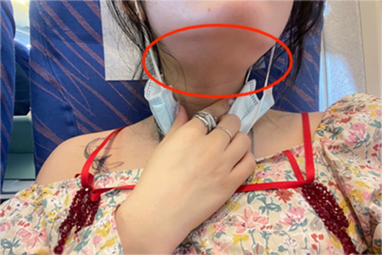 颌下腺炎下巴肿图