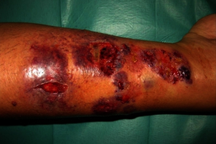 坏疽胳膊渗液图 坏疽胳膊渗液图