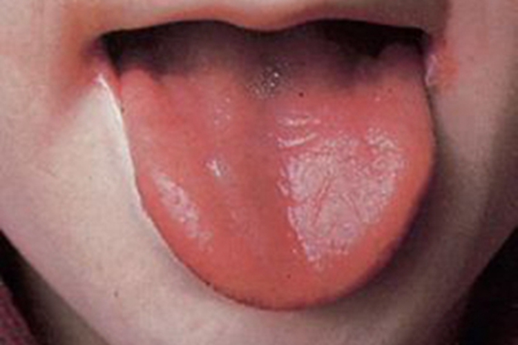 萎缩性舌炎舌头发红图 萎缩性舌炎舌头发红图