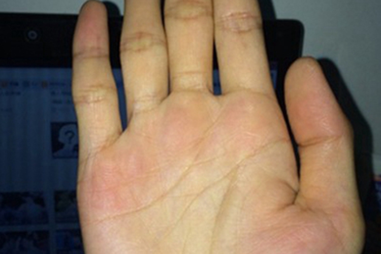 甲状腺功能减退症手掌皮肤发黄图