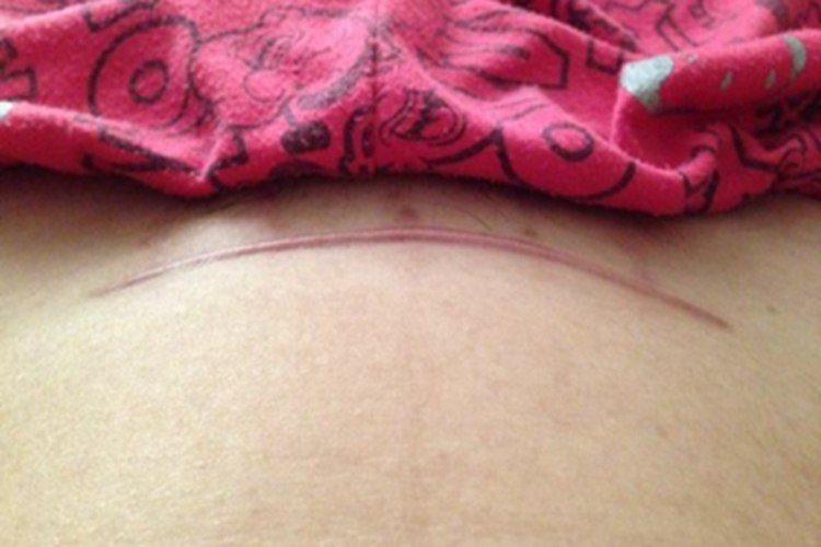 增生性瘢痕下腹有一条瘢痕图 增生性瘢痕下腹有一条瘢痕图