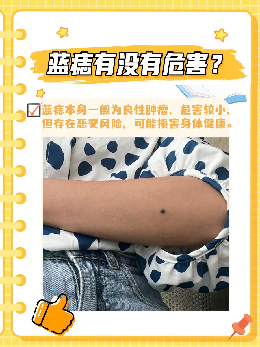 蓝痣有没有什么危害?一文带你全面了解!