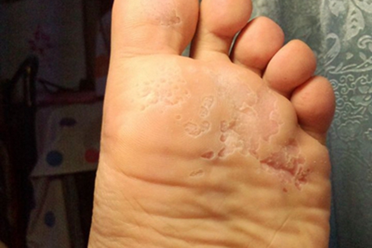 沟状跖部角质松解症脱皮图