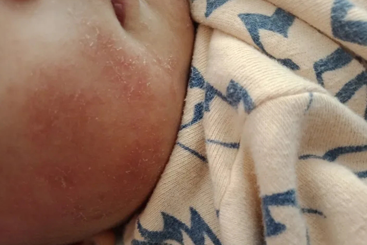 儿童日光性皮炎图