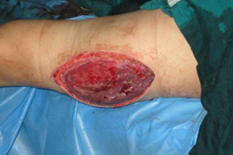 气性坏疽大腿肿裂图 气性坏疽大腿肿裂图