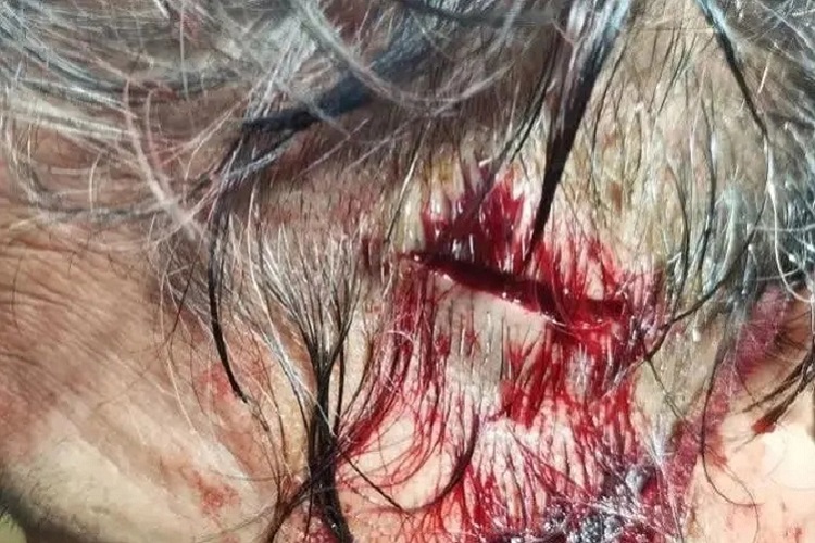 裂伤头皮裂口图 裂伤头皮裂口图